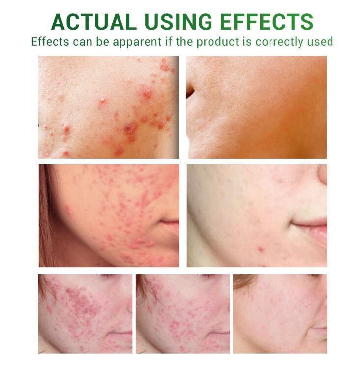 Acne Treatment Serum Facial Repair Oil - Swefashionstore