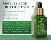 Acne Treatment Serum Facial Repair Oil - Swefashionstore